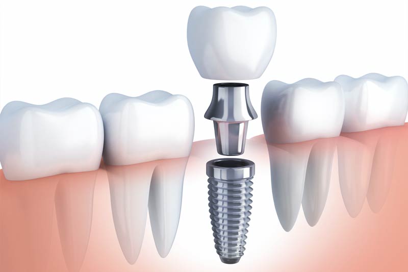Implants Dentist in Baxter
